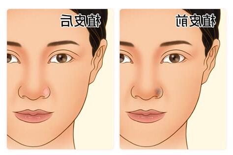 鼻孔 痣